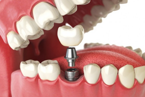 Implante dental